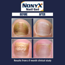 Load image into Gallery viewer, NONYX Fungal Nail Clarifying Gel, Clears Out Keratin Debris Where Nail Fungus Thrives, 4 oz.