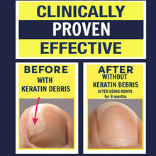 Load image into Gallery viewer, NONYX Fungal Nail Clarifying Gel, Clears Out Keratin Debris Where Nail Fungus Thrives, 4 oz.