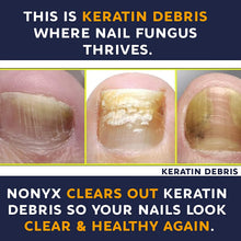 Load image into Gallery viewer, NONYX Fungal Nail Clarifying Gel, Clears Out Keratin Debris Where Nail Fungus Thrives, 4 oz.